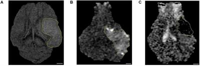 Dynamic Changes in the Gut Microbiome at the Acute Stage of Ischemic Stroke in a Pig Model